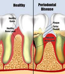 periodontal disease tooth